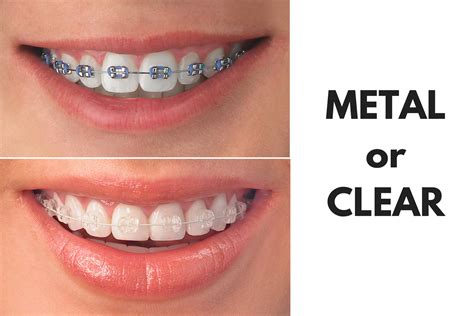 clear vs metal brackets|ceramic vs metal braces.